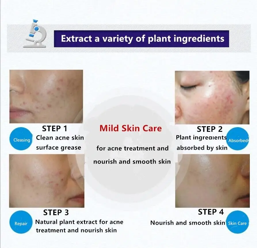 BIOAQUA марки Acne крем анти-акне удаления отбеливающий гель увлажняющий крем для лица 30 г масла Contorl уход за кожей