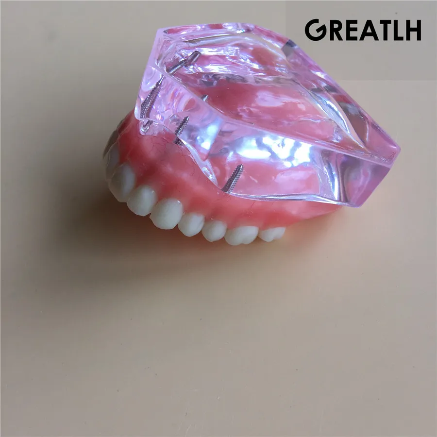 Модель зубного имплантата зубные зубы модель|dental tooth|teeth modeltooth teeth |