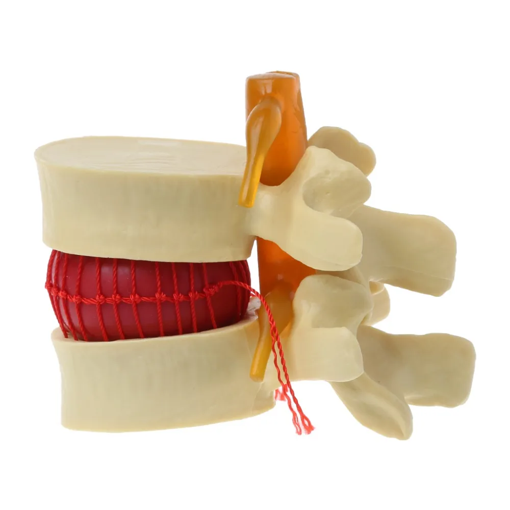 Anatomical Spine Lumbar Disc Herniation Anatomy Medical Model Teaching Tool School Supplies Instrume C26 | Канцтовары для офиса и