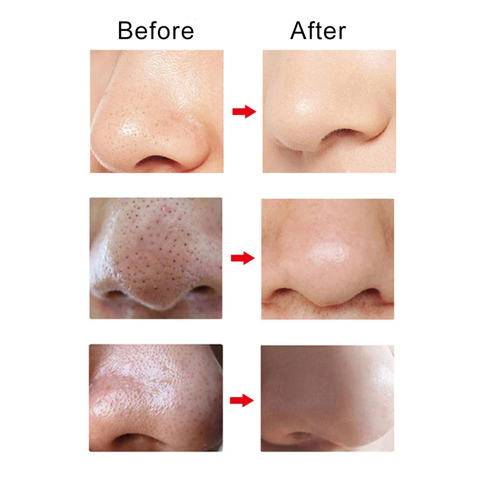 Акне черные точки удаление пятен прыщей инструмент для удаления угрей вакуумный