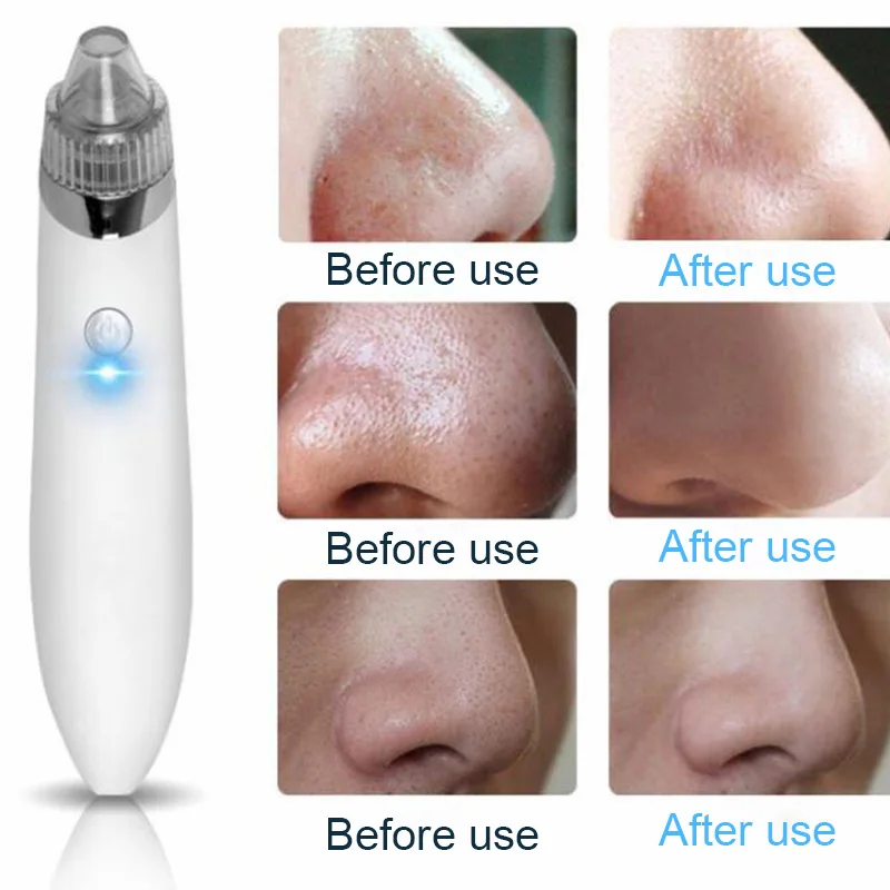 Вакуумный отсос для угрей Удаление Pro вакуумный аппарат очистки пор удаление