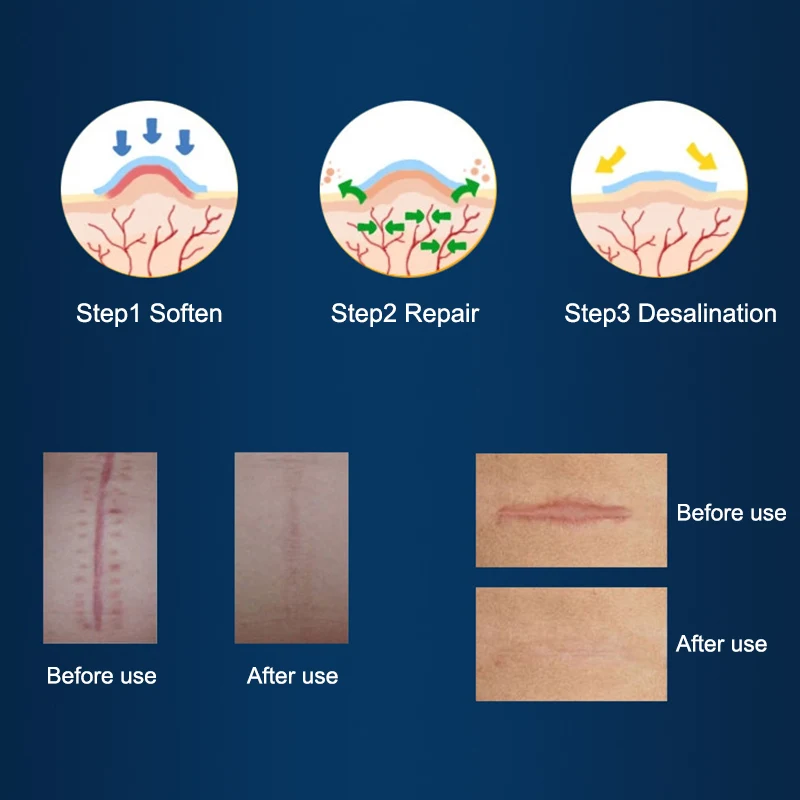 Силиконовый гелевый лист кесарево сечение хирургическое удаление шрамовый