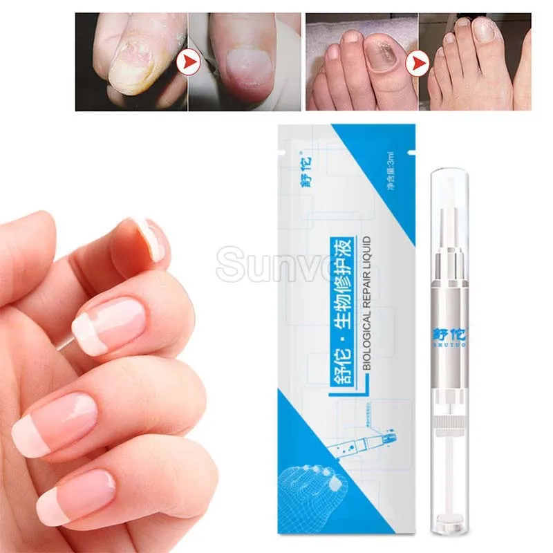 Крем для лечения Ногтей от грибков эссенция трав онихомикоза паронихии