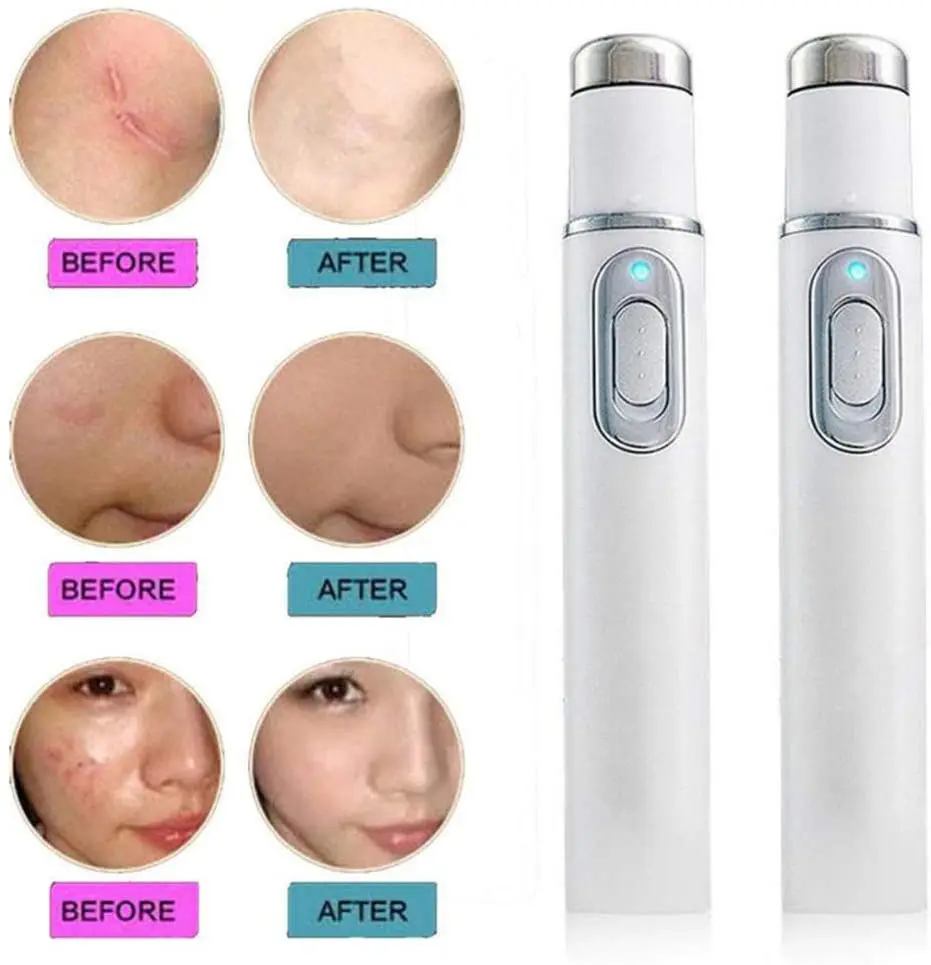 Лечение Варикозного расширения вен лечение акне сисветильник мягкое лазерное