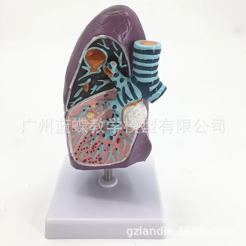 Медицинская модель медицинской анатомической патологии дыхания и легких| |