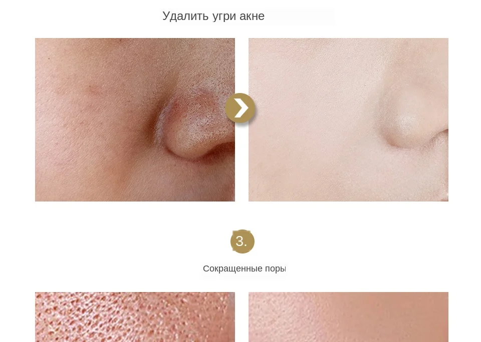 HEMEIEL Усадочные поры лица Сыворотка для удаления черных точек от угревой сыпи невидимое лечение пор укрепляющая кожу контроль масла увлажняющая отбеливающая сыворотка