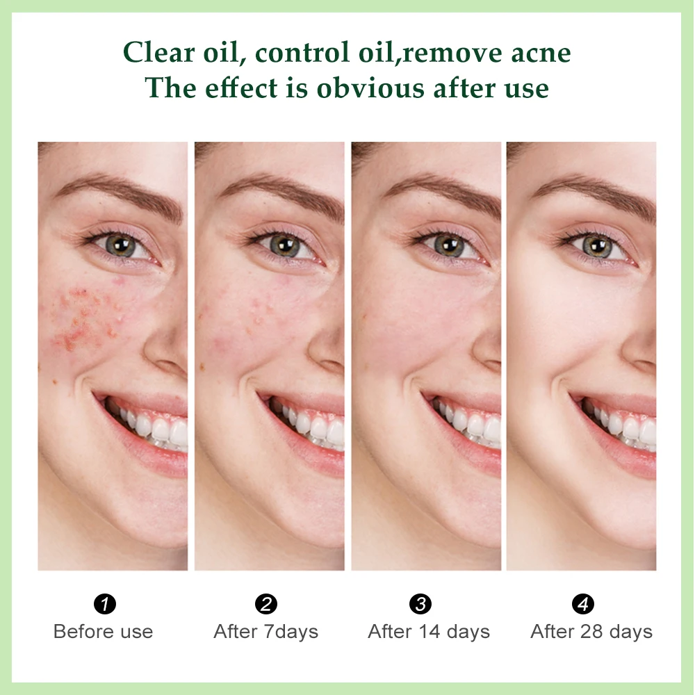 Пятна Отбеливание акне крем Женский гель для лица Восстанавливающий выцветающий
