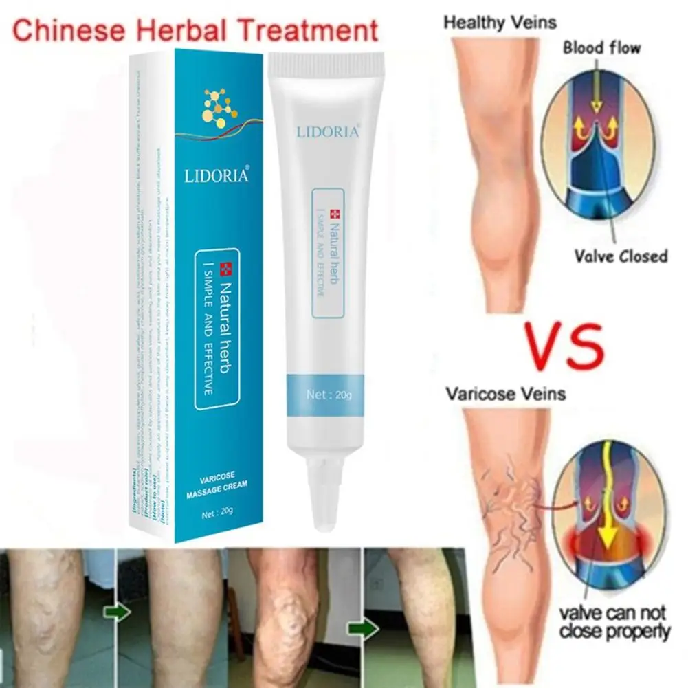 

Varicose Veins Ointment Vasculitis Treatment Phlebitis Angiitis Inflammation Blood Vessel Rotten Legs Varicose Veins Cream