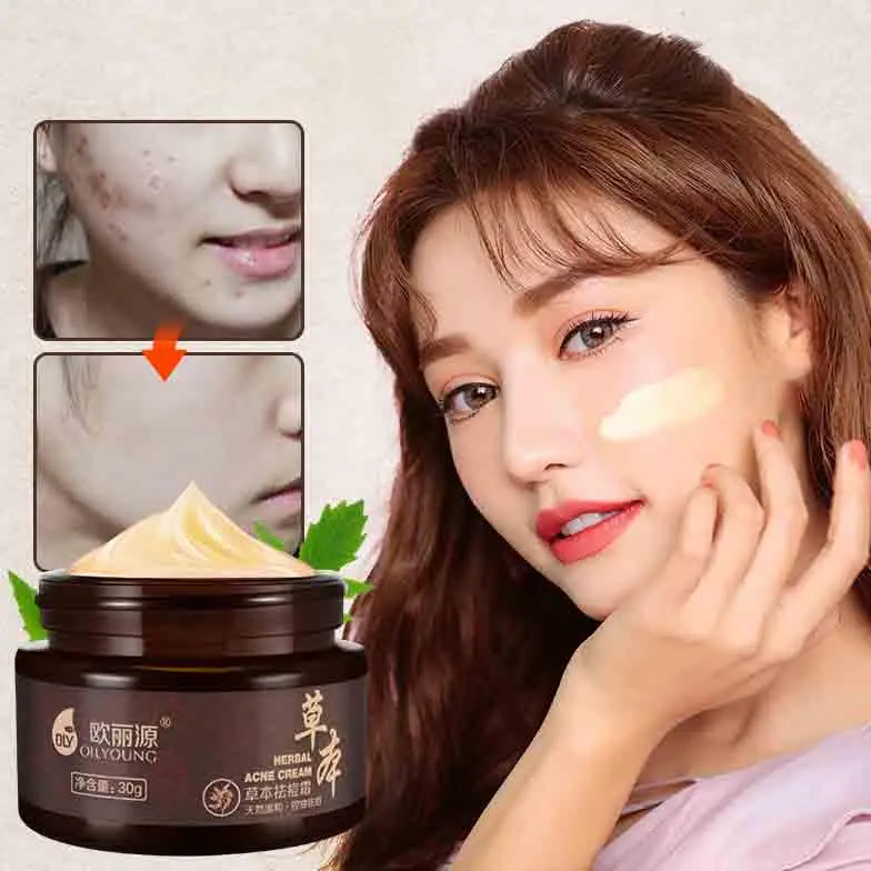 

Травяной крем для удаления черных точек, против прыщей, фотоотбеливающий крем для ухода за кожей