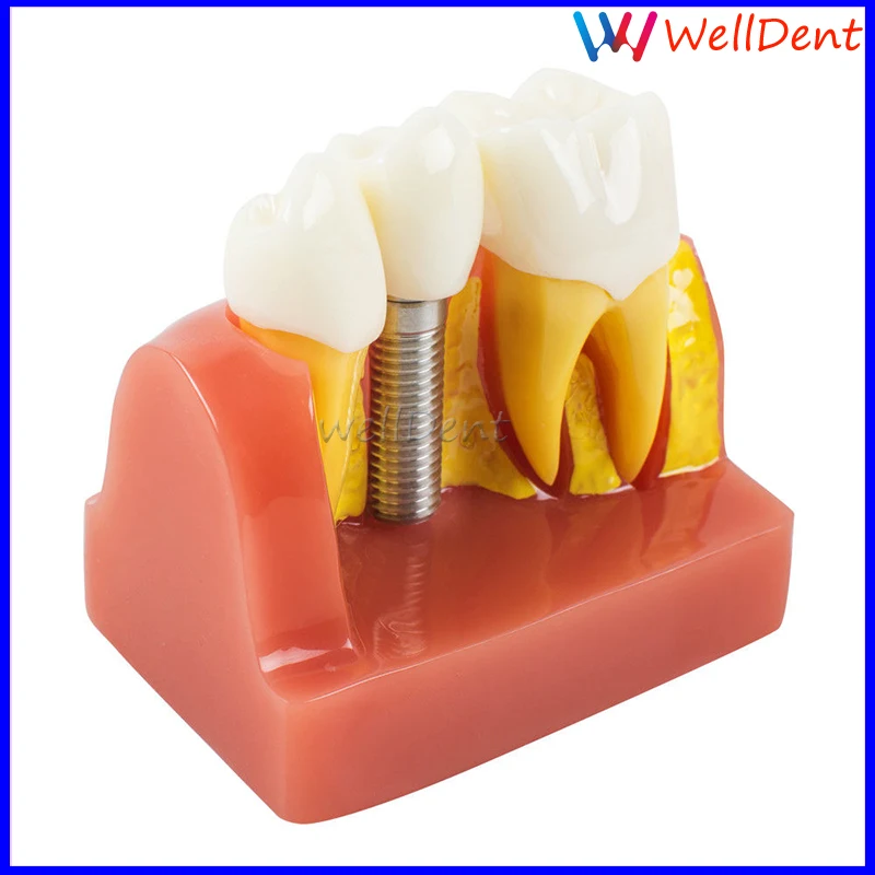 Стоматологическая зубная модель демонстрационный имплантант анализ Корона мост