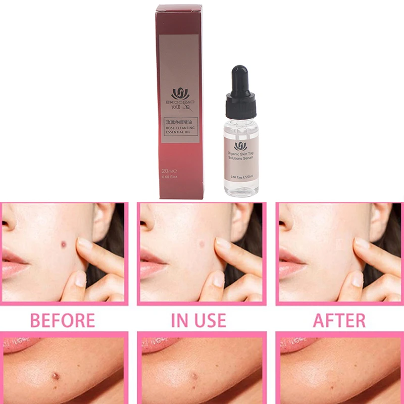 

Mighty Tag & Spots Remover Serum Painless Mole Skin Dark Spot Mole Removal Face Wart Tag Freckle Skin Tag Removal Cream
