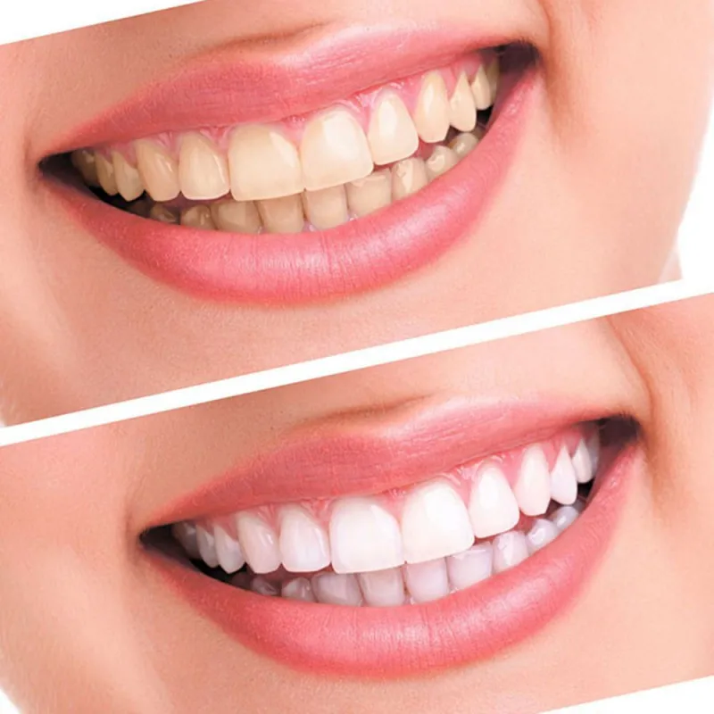 

Tooth Whitening Tooth Bleaching System Oral Gel Kit Tooth Whitening Gel