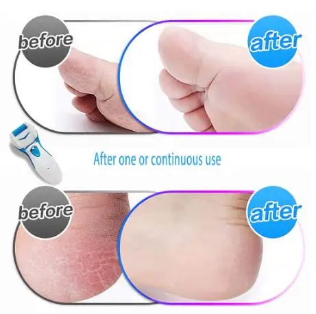 Электрическая пилка для ног аппарат удаления мозолей педикюрное устройство
