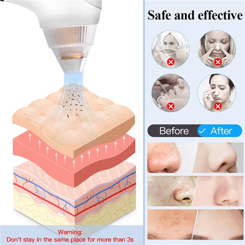

CkeyiN Visible Blackhead Remover WiFi Camera Facial Pore Vacuum 20X Microscope Nose Ance Pimple Suction Cleansing Rechargeable