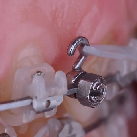 Ортодонтические обжимные замки Dentst с крючком (20 шт.)