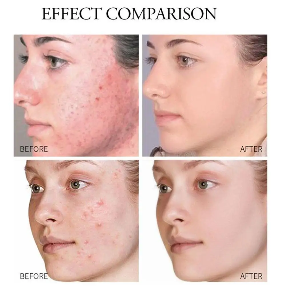 Ginseng Acne Treatment Cream Anti Acne Pimples Spot Herbal Remove Blackhead Skin Care Removal Whitening Cream Cream Scar Na U9E6