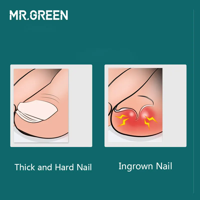 MR.GREEN инструменты для маникюра профессиональные из нержавеющей стали толстые ногти вросшие кусачки для кутикулы Триммер плоскогубцы ножницы кусачки для ногтей