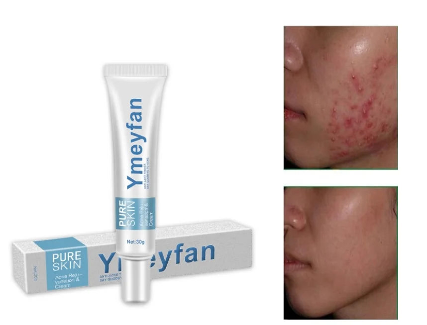 

100pcs Light Print Scars Removal Face Cream Beauty Pure Skin Care Whitening Facial Moisturizing Cream Acne Treatment Cream