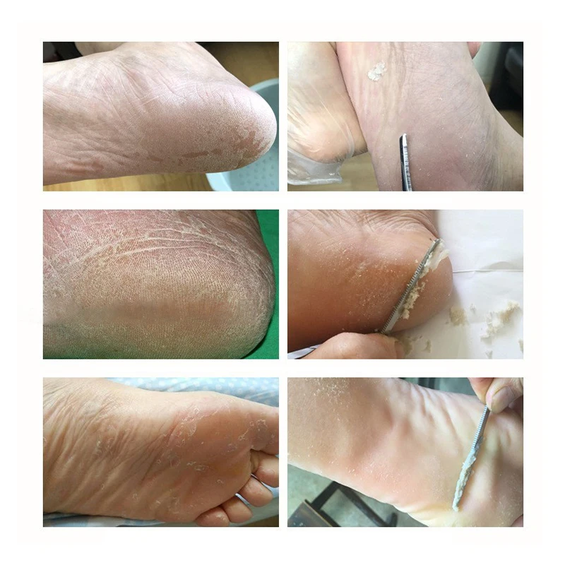 

Toe Pedicure Knife Nail Clipper Feet Scraper Tools Dead Skin Removers Nail Foot Care Tool Kit Ingrown Cuticle Tools