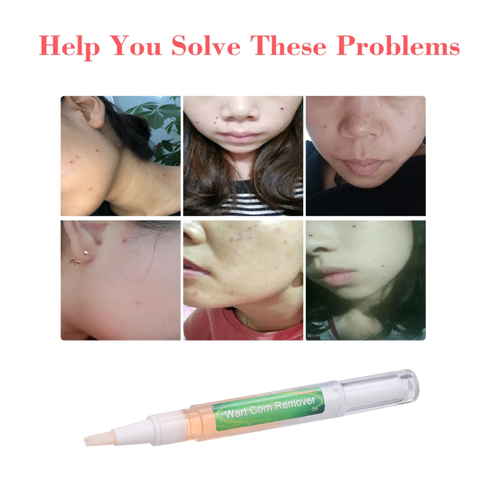 Ручка для удаления бородавок кукурузы лечение инфекции восстановление ног