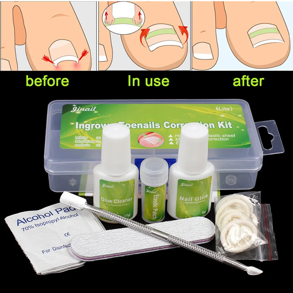 

12pcs/1 Set Ingrown Toenail Correction Set Paronychia Elastic Patch Straightening Stickers (Mild)
