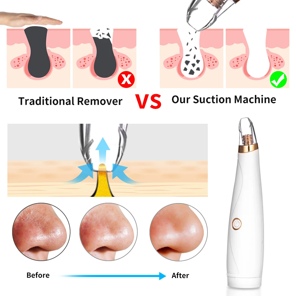 Новинка средство для удаления черных точек лица прыщей пор ухода за кожей