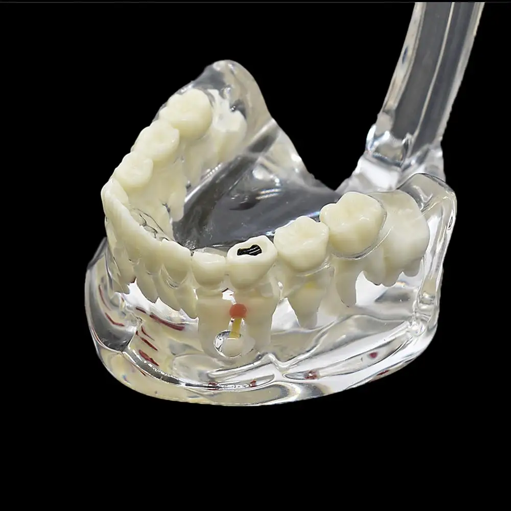 Стоматологическая детская модель патологических зубов Ортодонтическая для