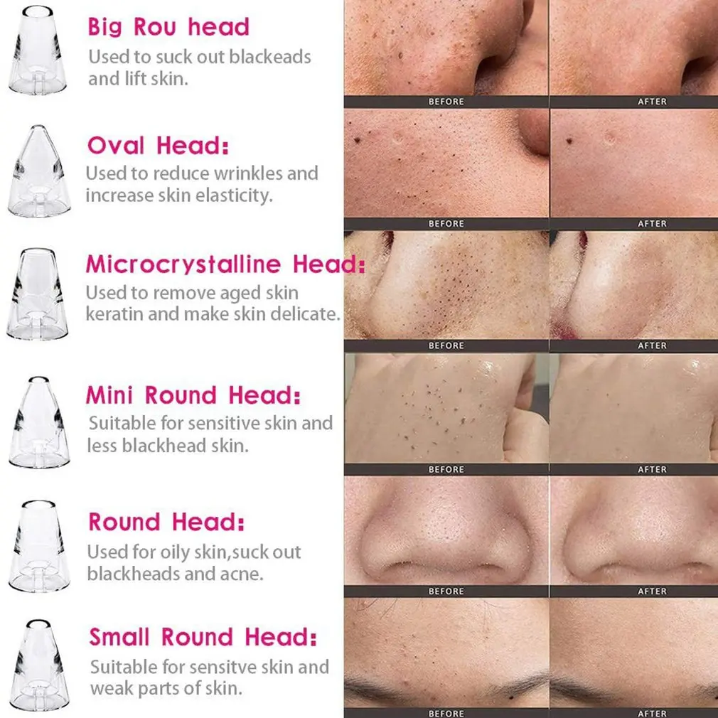 USB-устройство для удаления черных точек 6 сменных головок | Красота и здоровье