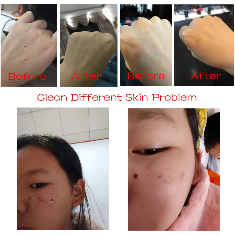 6 уровневый светодиодный лазерный аппарат для удаления веснушек кожи моль