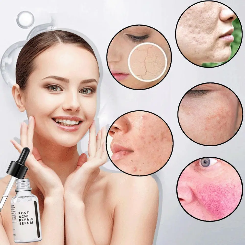 

30ml Salicylic Acid 2% Solution Removes Acne Face Serum Spot Fade Face Care Pore Moisturizing Essence Skin Brighten Shrinks L9a3