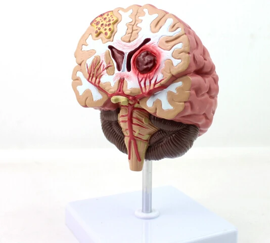 

1:1 Humans Brain Disease Model Brain Anatomical Model Neurosurgery Cerebral Hemorrhage Brain Pathological Medical Teaching Model