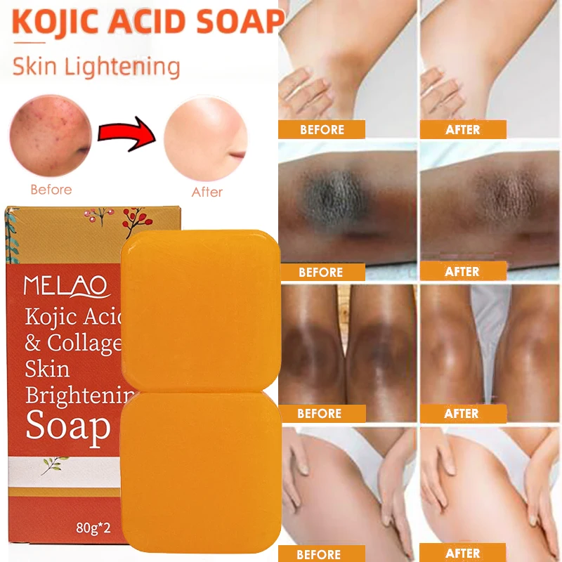 

Kojic Acid Soap Skin Dark Spot Whitening Lightening Brightening Anti Acne Organic Handmade Kojie San Bath For Face & Body 80g