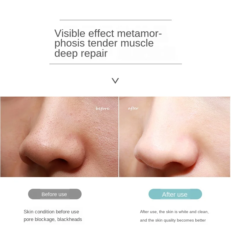 Удаляющий аспиратор для лица от акне Алмазный аппарат удаления и прыщей шейный