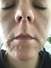 2 мл TCA PEEL! Набор для очистки кожи 35% удаляет татуировки возрастные пятна шрамы