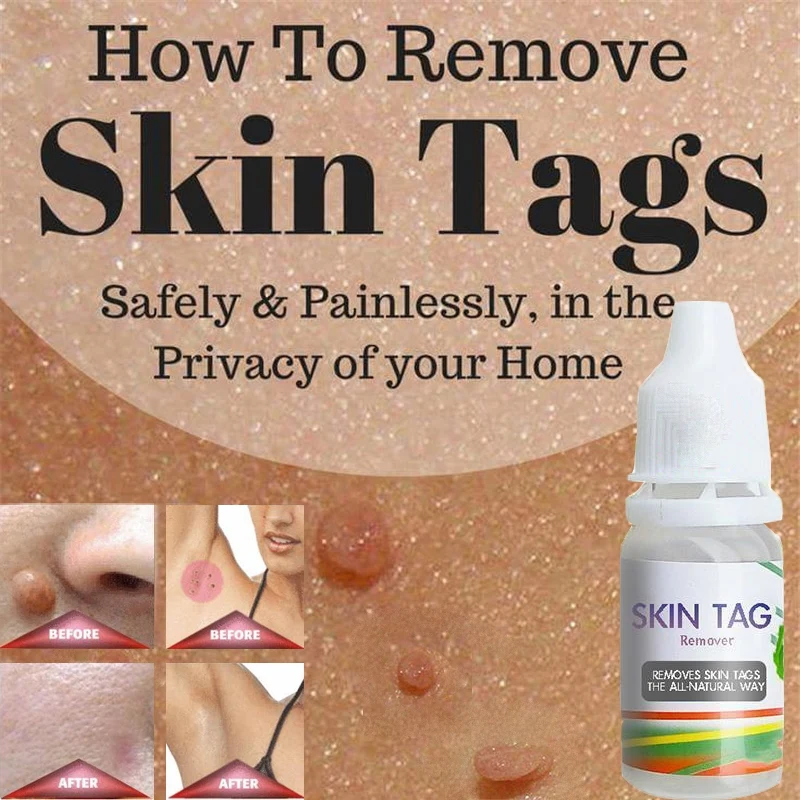 

Hot Skin Tag Remover Corn Eye Treatment Solution Corns Exfoliator Callus Removal Liquid Foot Skin Care Product