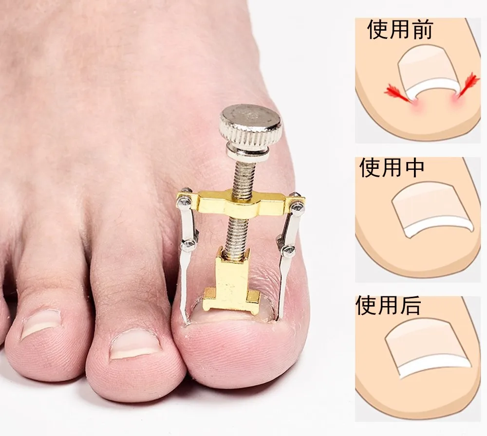 

Инструмент для коррекции вросших ногтей, 1 шт., инструмент для педикюра закрепитель для ногтей на ногах, Уход за ногтями на ногах, ортопедиче...