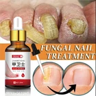 Средство для лечения грибков ногтей, эссенция для ухода за ногами, отбеливание ногтей на ногах, удаление грибка на ногтях, антиинфекционный гель для лечения паронихии и онихомикоза