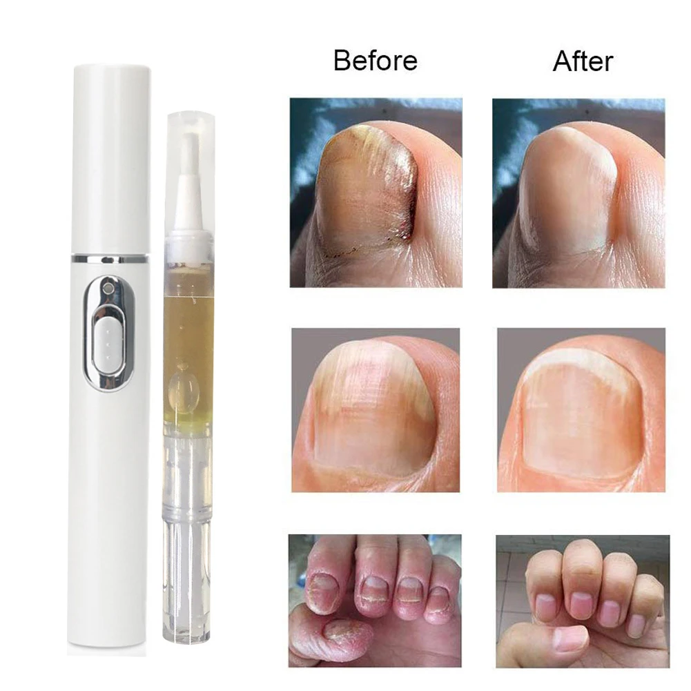 

Relaxing Travel Wrinkle Removal Acne Pen Home Multifunction Scar Durable Dark Circles Blue Light Therapy Massage Portable