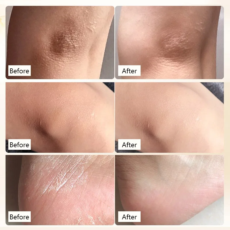 

Japan Cosmetics Foot Peeling Spray Natural Orange Essence Pedicure Hands Dead Skin Exfoliator Mask Whiten Baby Foot Care Tool