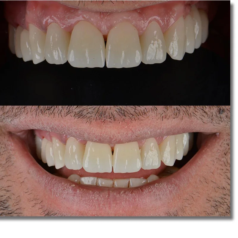 ST + предварительно затененные цирконы Zahn(95 мм) (толщина 14 Beautyzir стоматологические