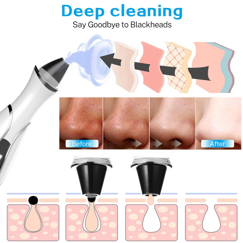 

Blackhead Remover Vacuum Pore Cleaner Acne Pimple Removal Tool Face Cleanser Blackhead Vacuum Dropshipping