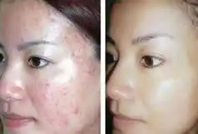 Рисунок 3 - Набор сушеных в замораживании порошков