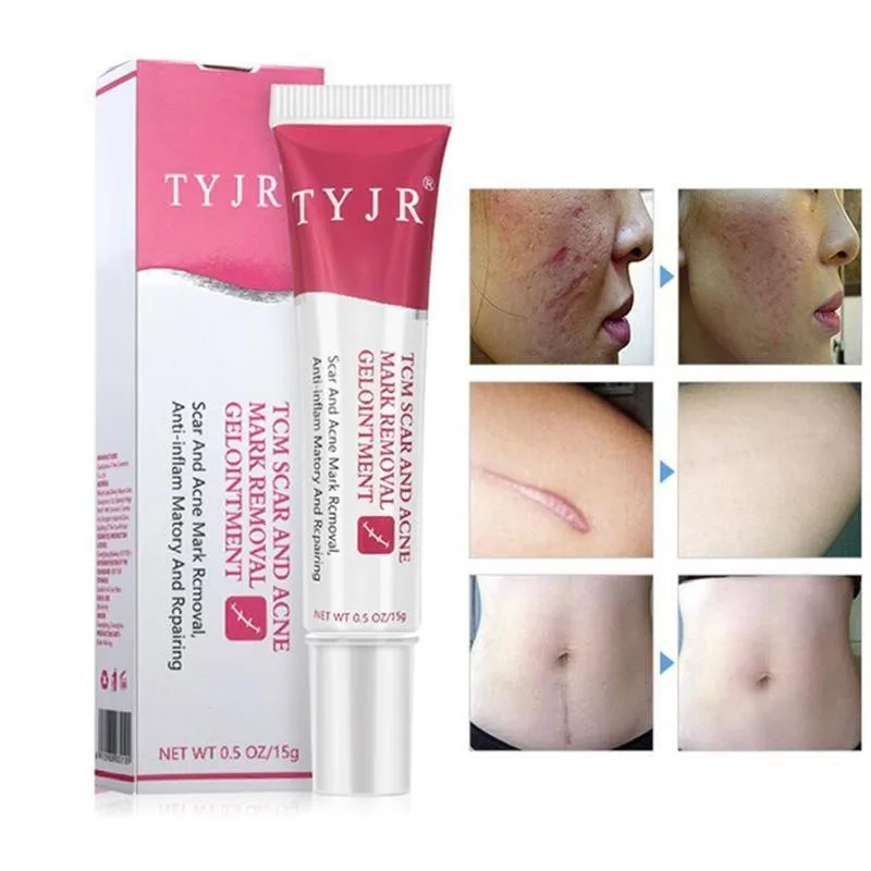 

Body & Face Scar Removal Cream New Old Scar Repair Cream Scar Repair Gel Damaged Ance Stretch Skin Marks Surgery T0Z0