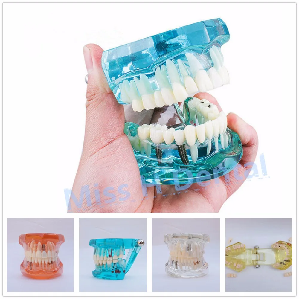 Модель зубного имплантата учебное пособие с мостиком для восстановления зубов