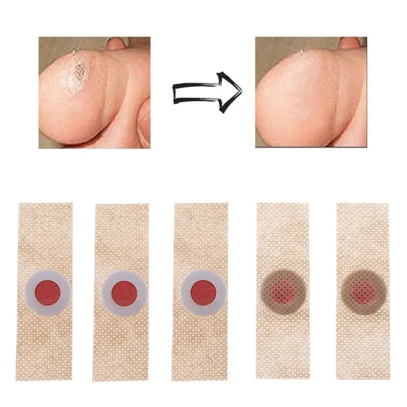 Безболезненный Уход за ногами средство для удаления мозолей ног бородавок шип