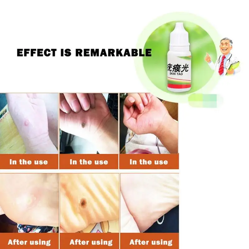 10 мл кожу средство удаления бирок моль женских половых органов для бородавок
