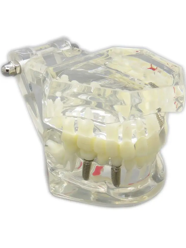 Dental Implant Standard Pathological Removable Tooth Teaching Model Transparent M2001C