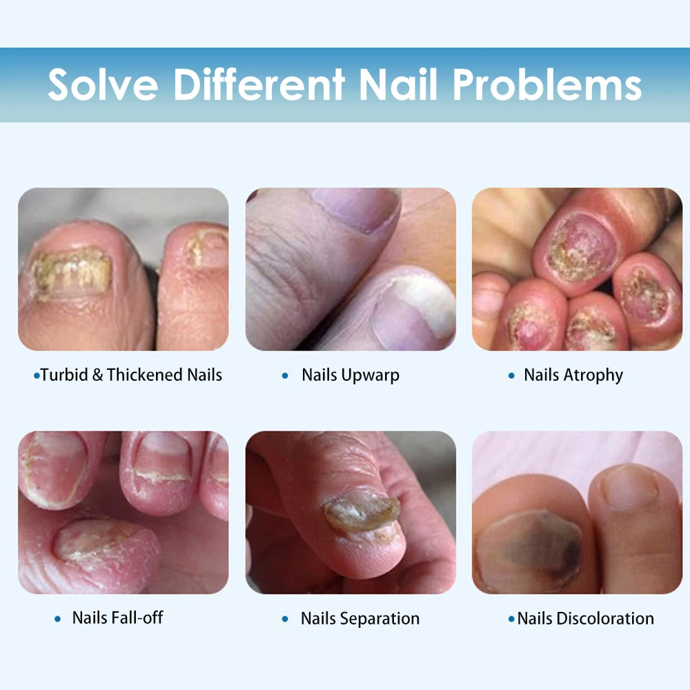 2 шт. 3 мл ручка для лечения Ногтей онихомикоз паронихия противогрибковая