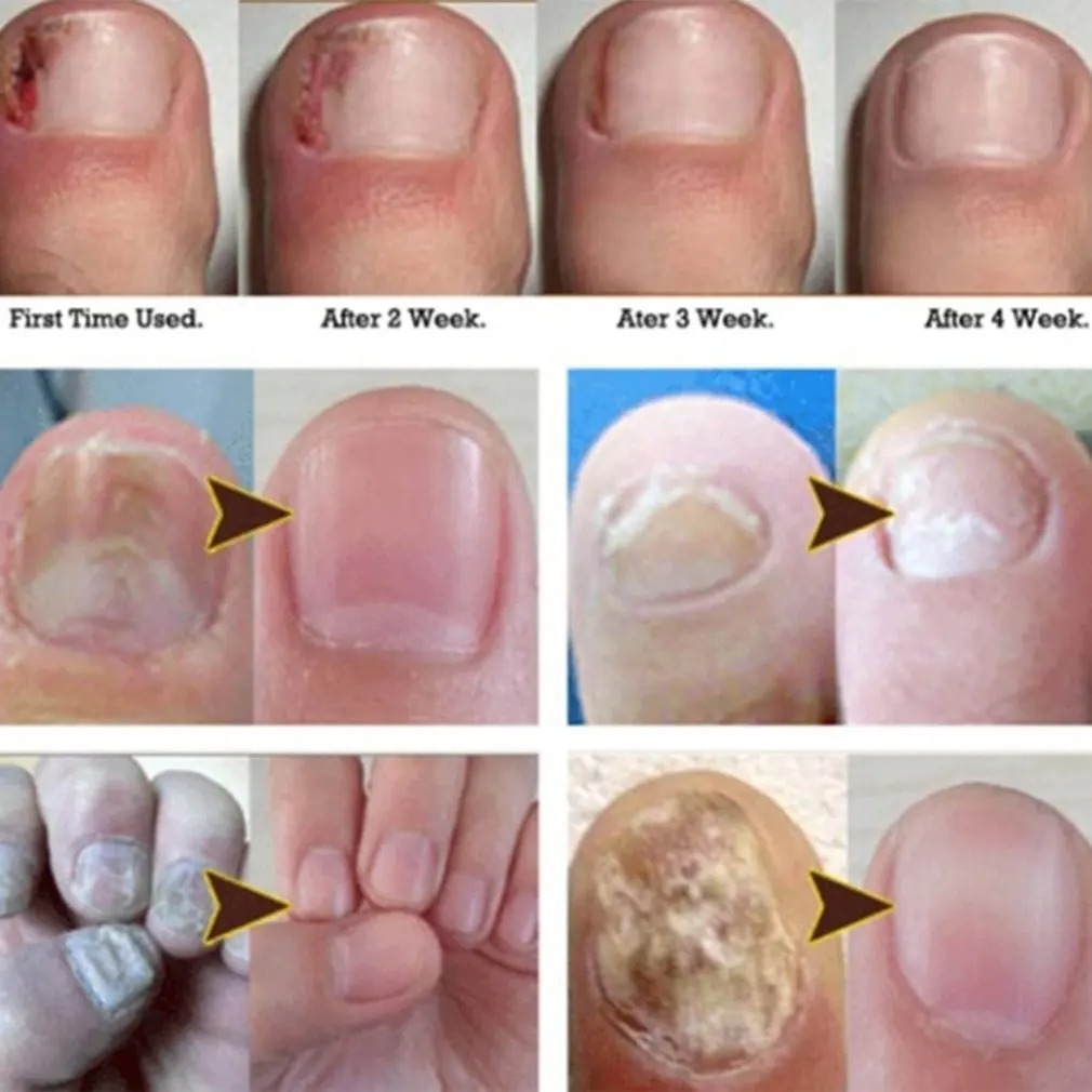 10 мл натуральный Уход за ногтями уход здоровой кожей для ухода лечение жидкое