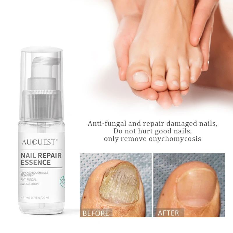 Средство для лечения Ногтей от грибков онихомикоз паронихия противогрибковая